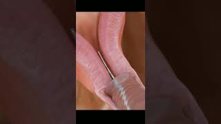 Insertion of IUD (Intrauterine Device) to Prevent Pregnancy | Birth Control #4k #animation #asmr