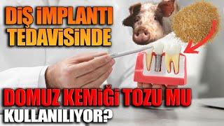 Diş implantı tedavisinde domuz kemiği tozu mu kullanılıyor?