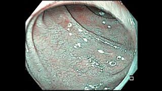 Celiac disease   Endoscopic findings