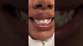 Dental Veneers for you at Dentatur in Turkey! #dentatur #smiledesignturkey #dentalveneersturkey