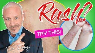 HOW TO TREAT A RASH!   |  Dr. Doug Willen