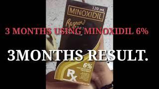 Minoxidil 6percent 3 months result.