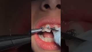 How bracket are Placed on tooth|How Braces are Put on tooth|Orthodontic Treatment |Orthodontic