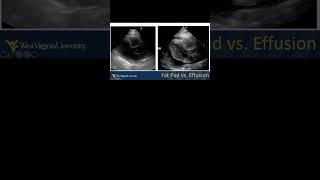 Pericardial Effusion vs. Fat Pad #emergencymedicine #POCUS #echo #echofirst #FOAMed #FOAMus