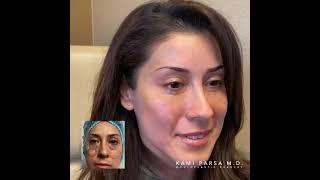 Patient Story | Kami Parsa, M.D. Oculoplastic Surgeon LA | Eliminate Puffy Lower Eyelids, Eye Bags