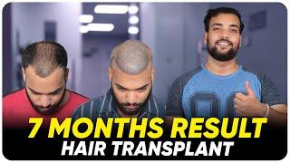 Hair Transplant in Chennai | Best Results & Cost of Hair Transplant in Chennai