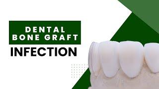 Dental Bone Graft Infection: 5 Causes You Should Look For