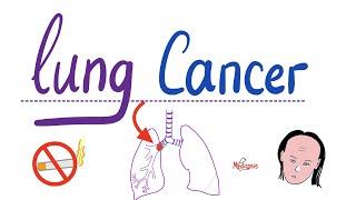 Lung Cancer - Bronchogenic Carcinoma - The most COMPREHENSIVE Explanation