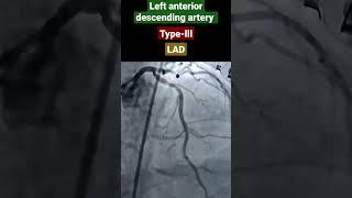 LAD, left anterior descending artery type-lll angiography, widow Maker Artery #shorts