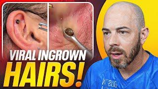 Best Pimple Pops and Ingrown Hair Extractions From The Internet!