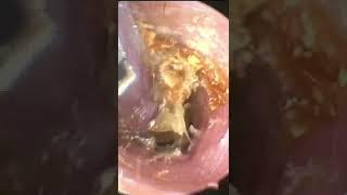 EAR WAX REMOVAL #Shorts