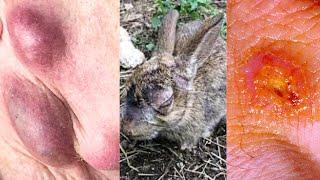 WHAT IS TULAREMIA? SYMPTOMS, CAUSES, TREATMENT