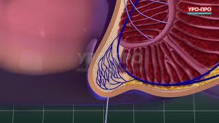 Лечение геморроя лазером в клинике "УРО-ПРО"
