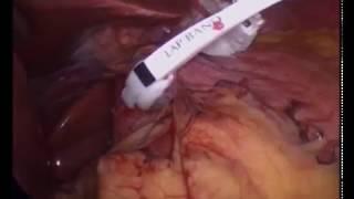 Laparoscopic Gastric Banding
