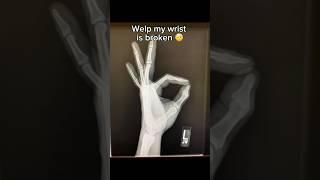 This broke my wrist  #gymnastics #gymnast #sports #fails #wrist #olympics #olympic #fail #ncaa