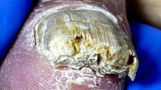 Toenails Are Like Withered Wood, With Debris Flying Everywhere【Pedicure Master Lin Jun】