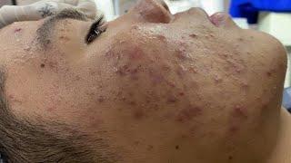 Acne Treatment DA Channel| Blackheads & Whiteheads Removal  New 2025 #30124