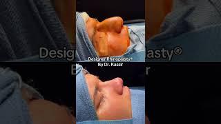 NYC Best Male Nose job #malerhinoplasty #malenosejob #rhinoplastyformen #bestnosejob #surgery