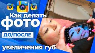 Как делать фотографии ДО/ПОСЛЕ увеличения губ