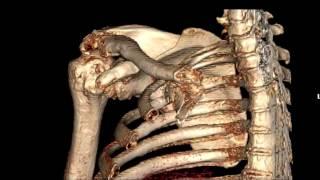 Shoulder Replacement Surgery Video