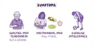 Median Arcuate Ligament Syndrome (MALS) Los Angeles, CA | Dr. Danny Shouhed