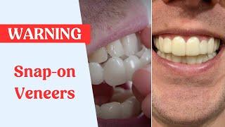 Snap On Veneers Warning