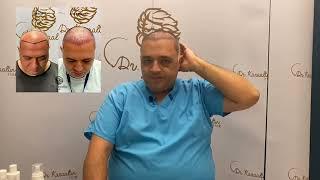 Prof. Dr. Mehmet Veli Karaaltin Hair Transplant Journey / Post Operation Update of 2 Weeks