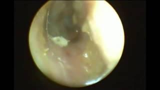 Endoscopic Myringotomy and Grommet Insertion Under Local Anesthesia  MEDtube