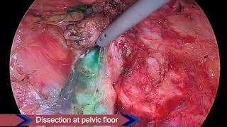 Laparoscopic total proctocolectomy withh ileal pouch anal anastomosis