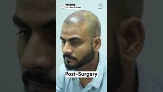 Amazing Hair Transplant Surgery | Latest Fue Technique #shorts #viral #hair transplant