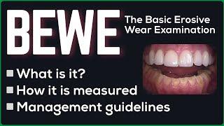 BEWE - The Basic Erosive Wear Examination explained