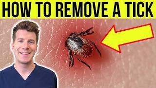 Doctor explains HOW TO REMOVE A TICK | Step-by-step guide