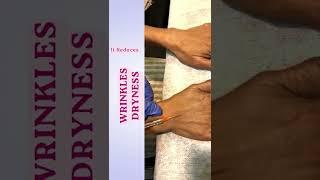 Dr Kiran |Dermal Fillers Treatment | Hand Rejuvenation | Dermatologists| Cosmetologist| Andheri West