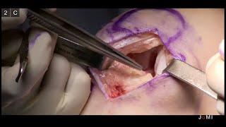 Femoral Resurfacing by Matthew Provencher MD (Links to Full Procedure)