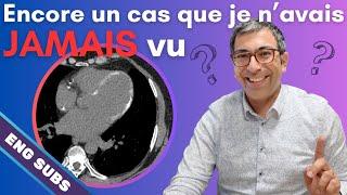 [ENG subs] A cardiac CT I've never seen before? Extensive myocardial calcifications