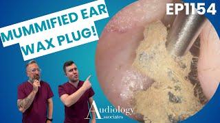 Mummified Ear Wax Extraction – You Won’t Believe This! - EP1154