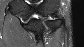 Lateral epicondylitis elbow