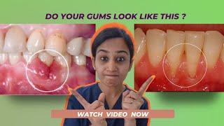 Importance of Gums Health. Why gums bleed or decrease in height and teeth losing.