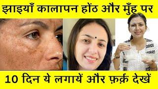 Melasma, Pigmentation, Dark Spots का 100% इलाज़ 10 Days Challenge | Upasana Ki Duniya