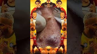 Blackheads Removal | Acne Treatment and Very Satisfying Satisfying Pimple pop #blackheads