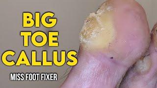 SHAVING OF REAL BIG TOE CALLUS   BIGGEST TOE CALLOUS EVER FULL TREATMENT BY MISS FOOT FIXER