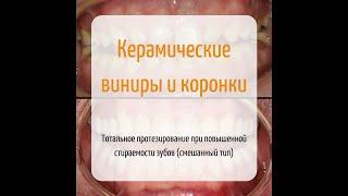 Керамические коронки и виниры при стираемости зубов смешанного типа.