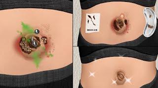 Is Your Belly Button Clean? ASMR Remove Navel Stone Animation | 배꼽 치료 애니메이션,피부과 치료