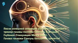 Голова госпожи Сонгуль больше не трясется! НЕ ОПОЗДАЙТЕ НА ЛЕЧЕНИЕ!  #дистония #тремор #dbs