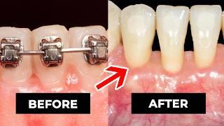 Are Braces FUELING Gum Recession?