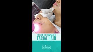 Laser Hair Removal for Chin