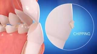 Invisalign Straight Talk Video