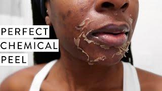 I TRIED A CHEMICAL PEEL! | Full Process, Before and After Dark Marks & Acne Scars