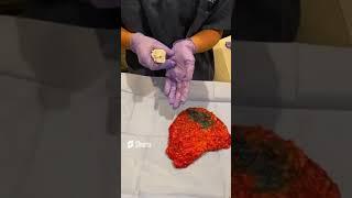 This Is How We Biopsy A Breast Tumor After Mastectomy