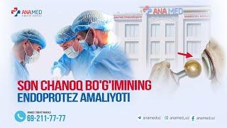 ANAMED tibbiyot markazida son-chanoq  bo'gimini endoprotezlash amaliyoti amalga oshirish boshlandi!